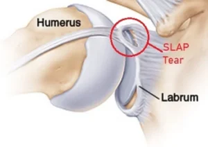 SLAP Tear